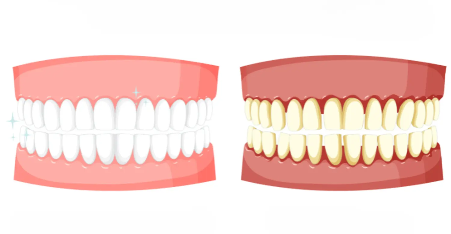 Gums Swollen After Flossing 2